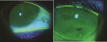 干眼症为什么要查过敏原,怎么判断是过敏还是干眼