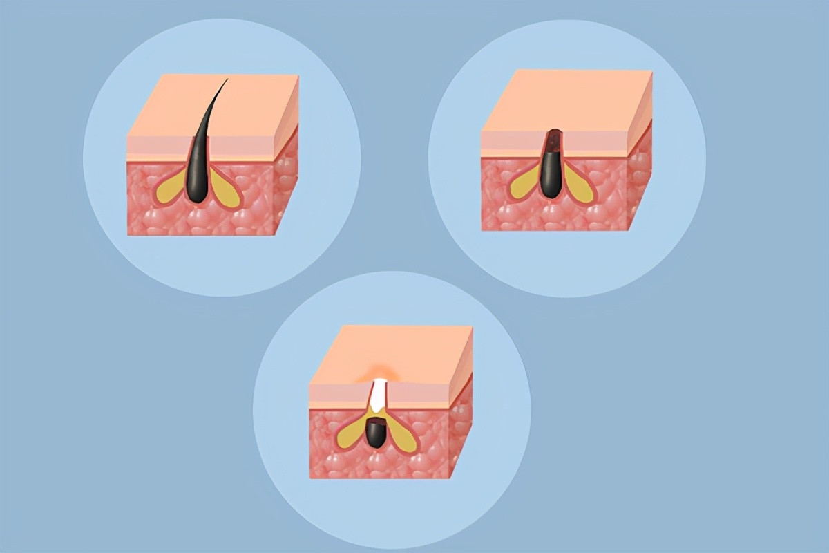 皮肤出油反反复复长痘怎么护肤,脸部出油严重是因为螨虫吗