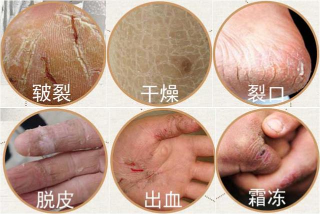 冬季皮肤皲裂用什么护肤品,冬季皮肤皲裂怎么办