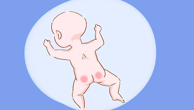 宝宝屁股破皮了怎么快速消除,宝宝屁股破皮最好方法