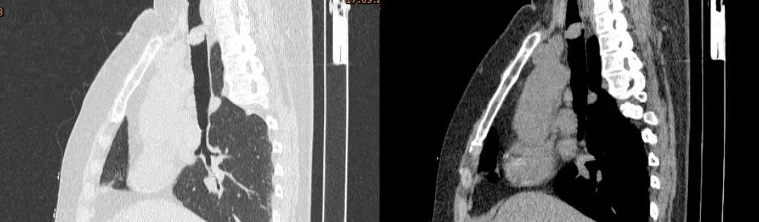儿童90%为良性,成人却不到10%?患者气短3年,胸部CT提示的气管肿物意味着什么?气管镜有何发现?