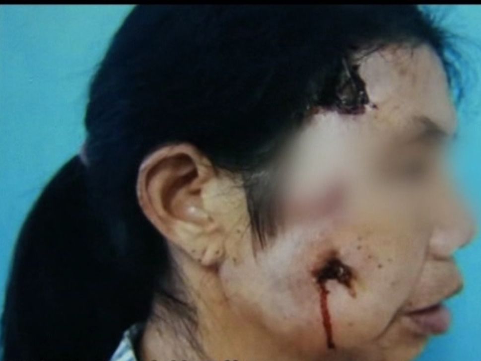 女子脸上长痘流脓,女的脸上流脓