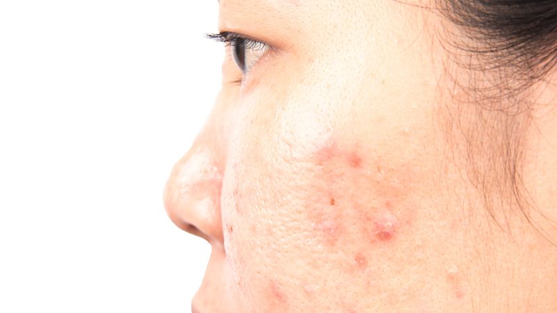 眉头长痘是哪里出问题了,眉头间祛痘最有效的方法