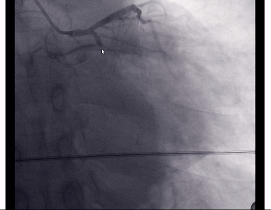 胸闷胸疼心脏彩超心电图ct没问题,胸疼但是心电图正常