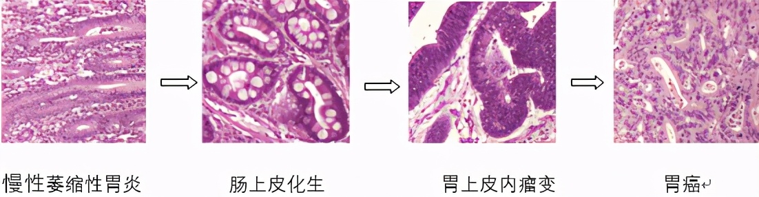 胃低级别上皮内瘤变该怎么办，到底是内镜随访还是行内镜切除？