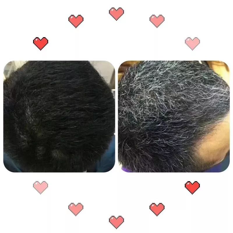 专家推荐治疗脱发白发食疗药酒,中医调理白发脱发养发