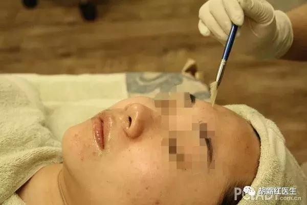 果酸换肤效果如何,果酸换肤的原理