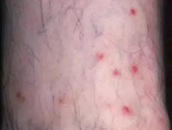 螨虫叮咬传播疾病,尘螨叮咬怎么治疗