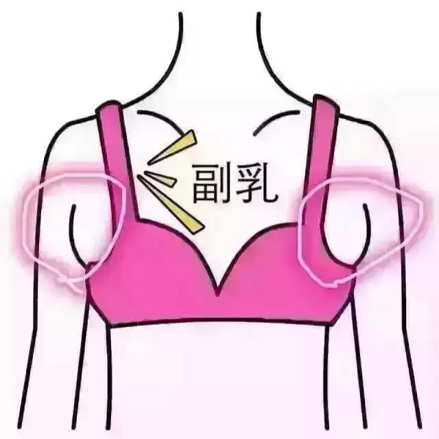 产后副乳最好的解决方法,产后副乳怎么才能消除