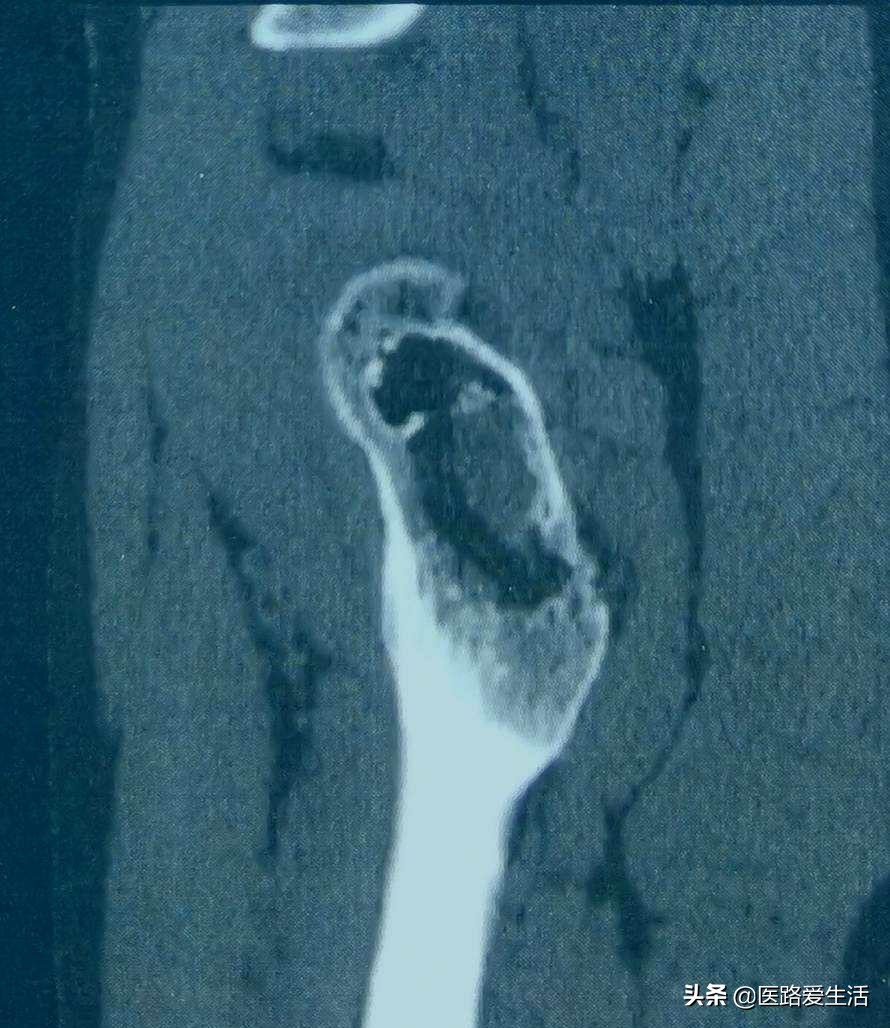 骨肿瘤能彻底治愈吗,骨肿瘤良性和恶性影像区别