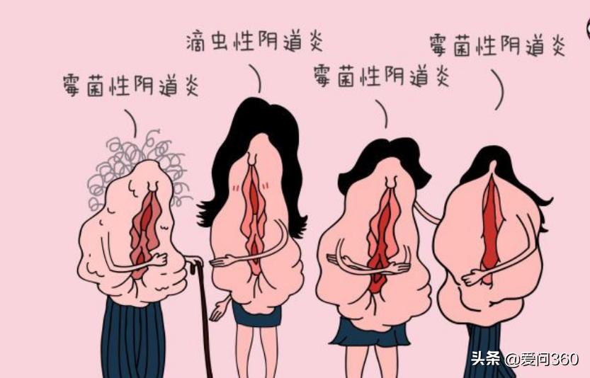 阴道炎症状怎么预防,阴道炎反复发作到底该怎么办