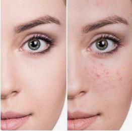 脸上痘印黑色素怎么消除,后背几年的痘印黑色素还能消除吗