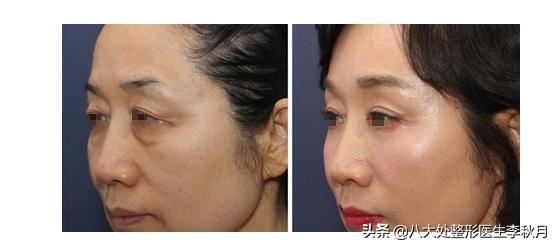 眼部细纹和眼袋泪沟怎么去除,赶走泪沟眼袋眼干没细纹