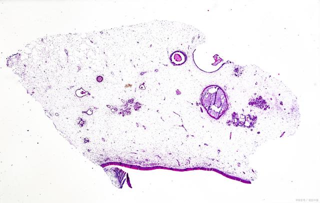 肛门息肉和痔疮症状怎么区别,长痔疮肛门狭窄有息肉该怎么治疗