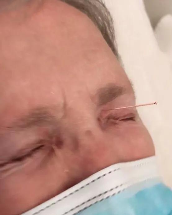 学习古法针灸点穴疗法,学习针灸的教学