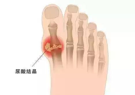 泡温泉为什么泡完指缝会疼,泡完温泉第二天浑身疼怎么回事