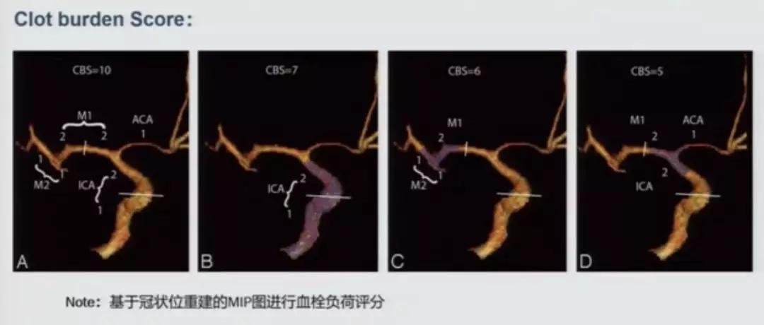 急性脑中风影像诊断选择,急性脑卒中首选哪种检查方法