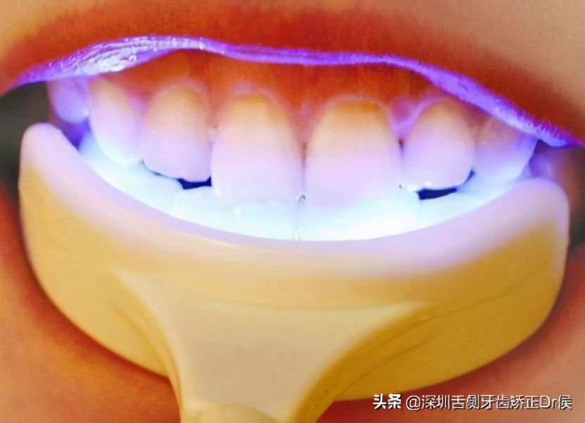 牙齿美白最好的方法价格,牙齿美白对牙齿有伤害吗