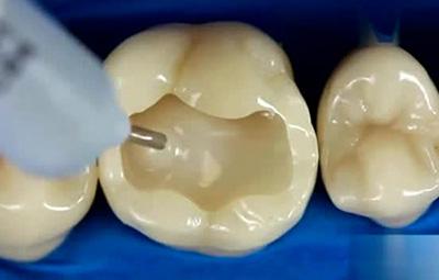 牙齿龋坏究竟要怎么办，补牙之后又能用多久呢？听听看牙医怎么说