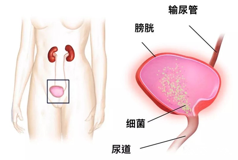 女人会尿急尿频尿不尽吗,为什么女人会尿频尿急尿不尽