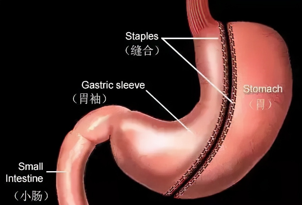 男子切胃,男子做切胃手术