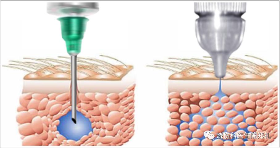 疤痕疙瘩怎么治疗最好最快,疤痕疙瘩中药治疗成功案例
