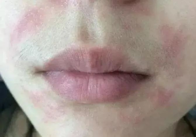 前胸后背长痘痘是毛囊炎吗,前胸后背很容易长痘痘中医治疗