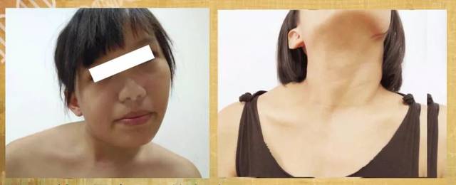 儿童神经系统引起的斜颈怎么治疗,哪个医院擅长治疗儿童斜颈