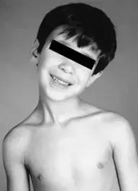 脖子突然往一边歪是怎么回事,孩子脖子突然歪了怎样矫正