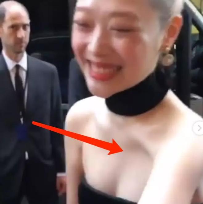 泫雅畸形锁骨,泫雅锁骨埋钉