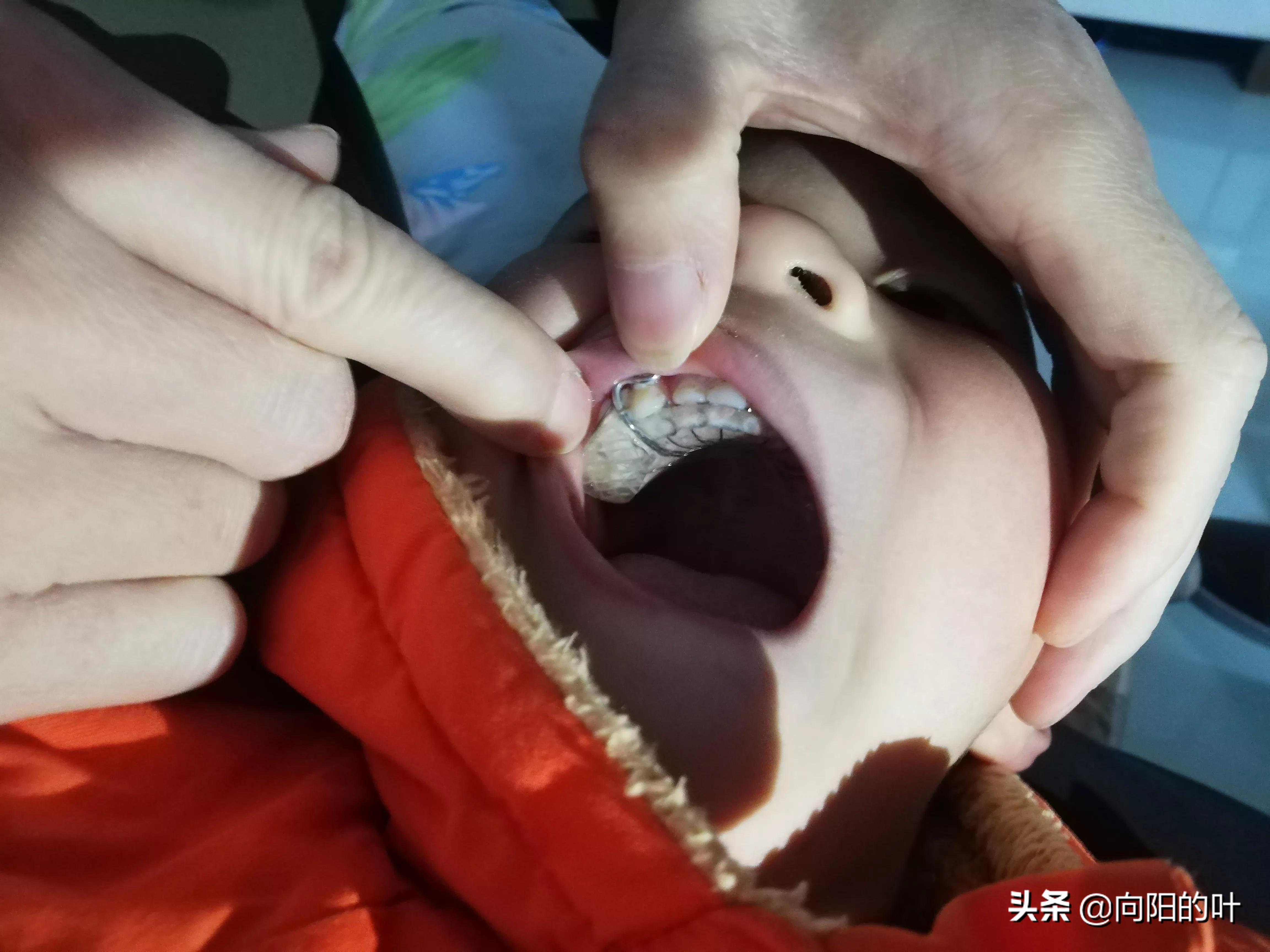 记录小儿兜牙治疗:开始带牙套了