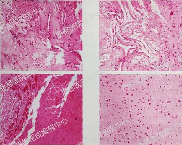 颞叶海绵状血管瘤癫痫微创手术,唐都医院脑肿瘤微创手术