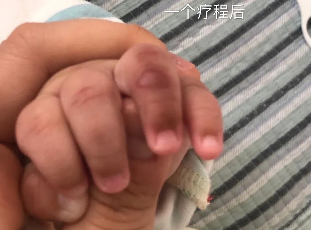 宝宝手指血管瘤治疗方法,手指头上长了个血管瘤怎么治疗