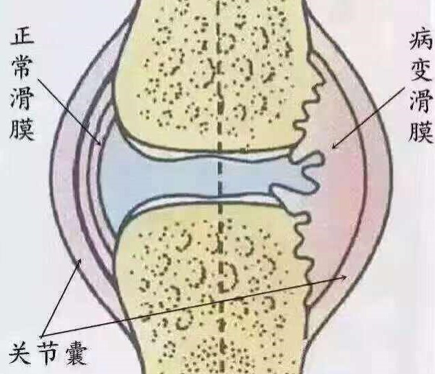 膝盖消肿了之后有积液,膝盖积液用土豆消肿行吗