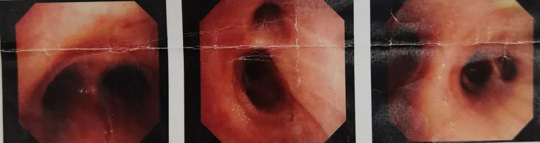 双肺多发结节，反复检查为何诊断重点成「盲区」？