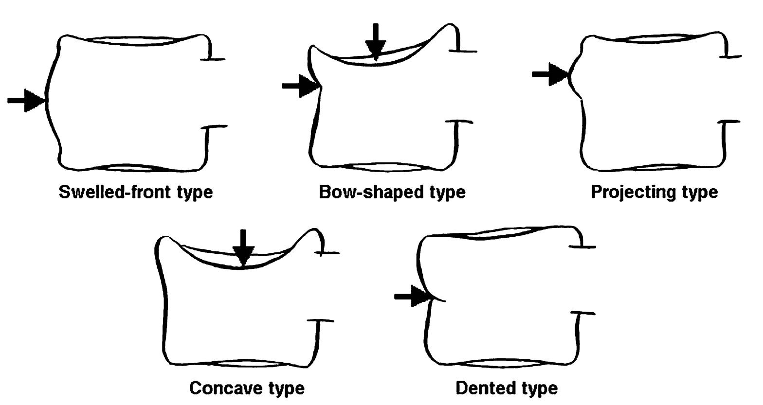 骨质疏松椎体压缩性骨折治疗指南,德国骨科骨质疏松骨折