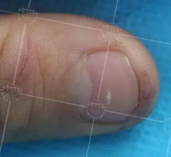 美甲会不会导致灰指甲,灰指甲脱甲液致癌