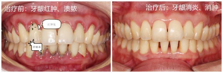 蛀牙与牙周炎哪个更严重,慢性牙周炎口腔健康的头号杀手