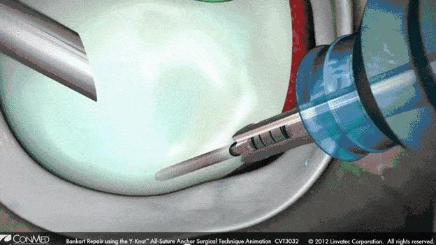 习惯性脱臼患者,习惯性脱臼一动就掉