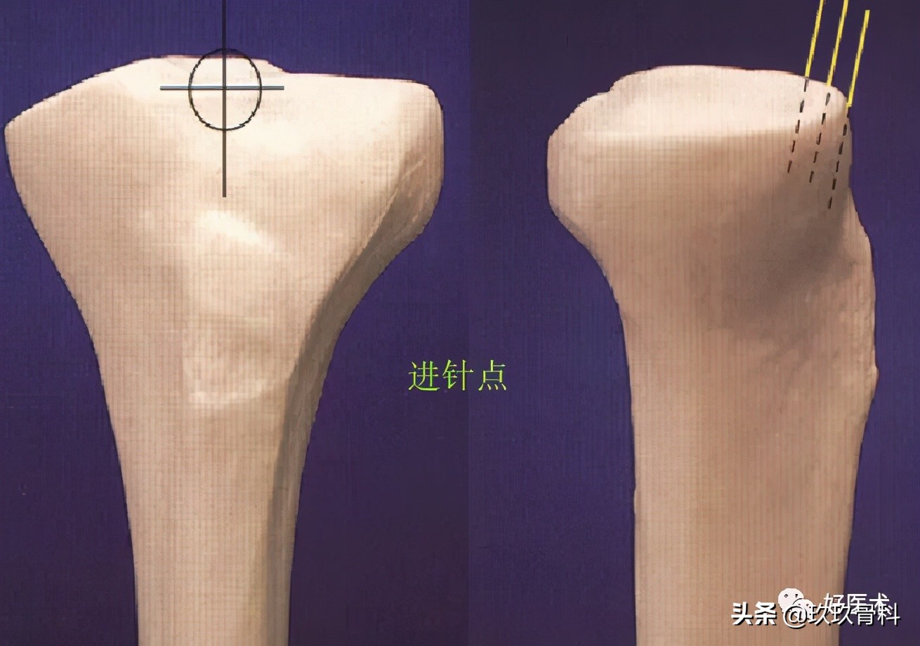 髓内钉技巧,髓内钉教学视频讲解