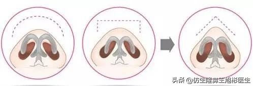 鼻尖高了怎么修复,鼻尖太大怎么矫正