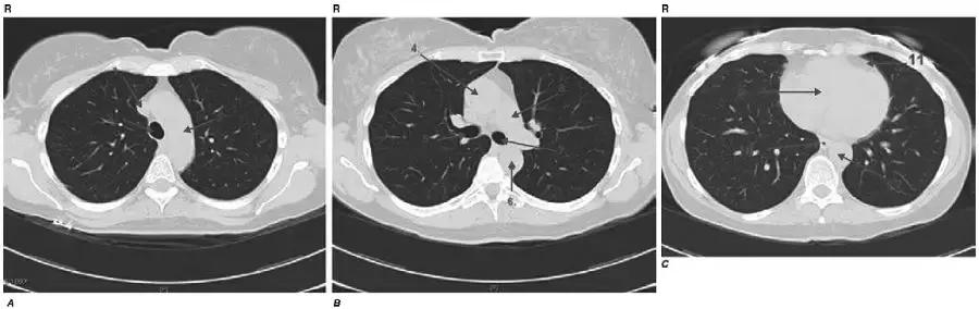 胸部影像解剖图谱书,胸部断层图谱