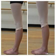 什么是膝盖过度伸展(膝盖超伸)?在瑜伽中怎么改善和正位?