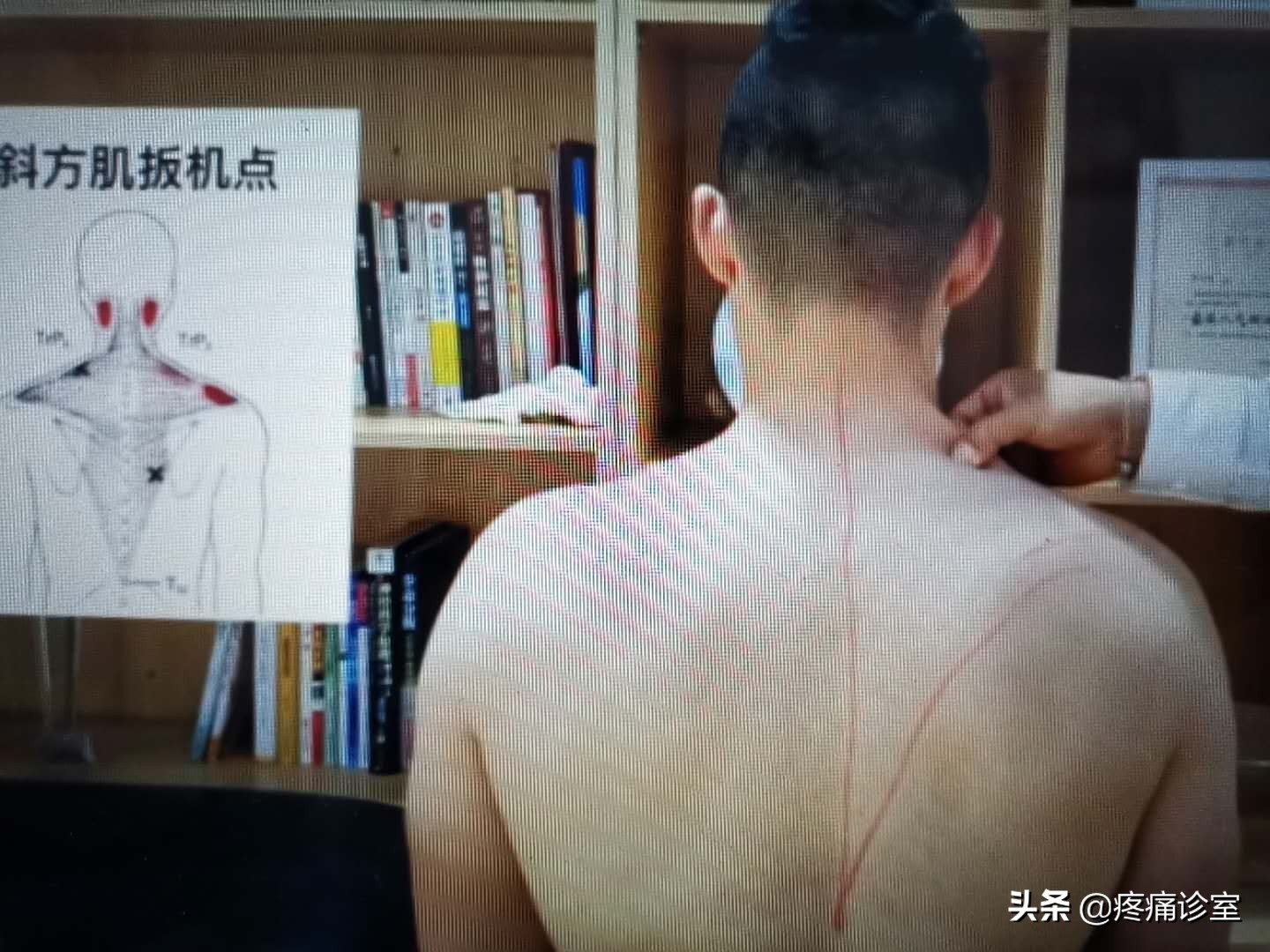 我的偏头痛怎么治好的,我的偏头痛一年多了反复发作