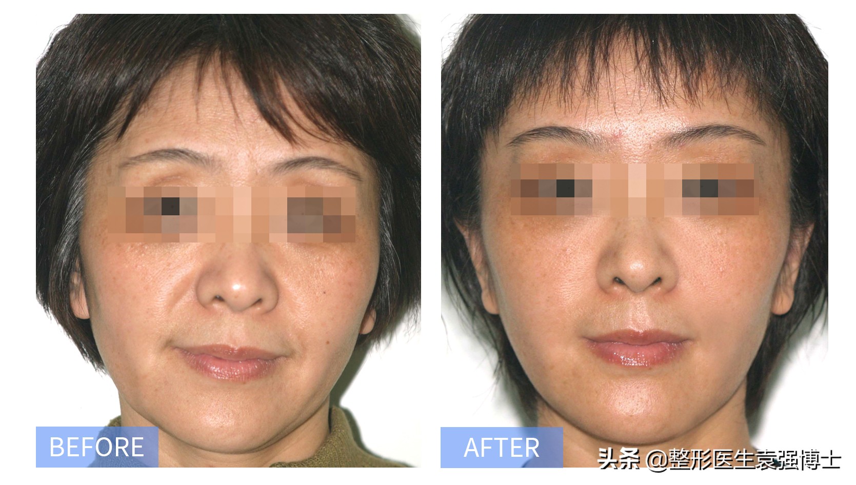 整形医生说医美后遗症,整容拉皮能拉法令纹吗