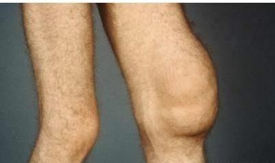 膝关节滑膜炎积液可以痊愈吗,滑膜炎膝盖积水能自愈吗