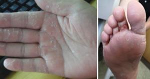 夏日如何远离体癣缠身你了解吗,长期皮癣体癣特别痒教你简单1招