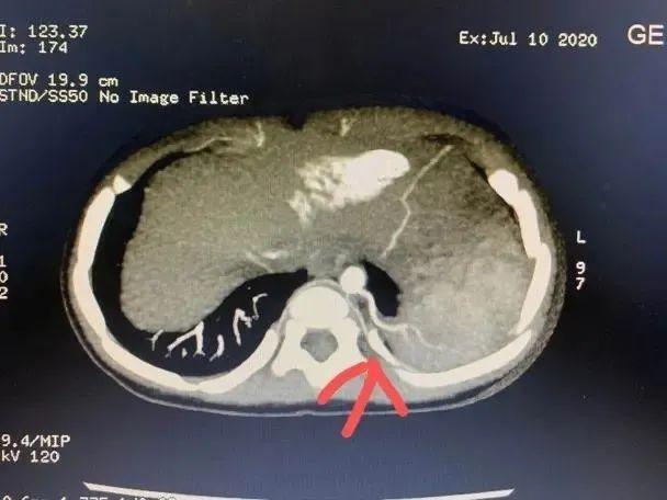 小孩咳嗽发烧已经3天,5个月宝宝咳嗽反复发烧38.5