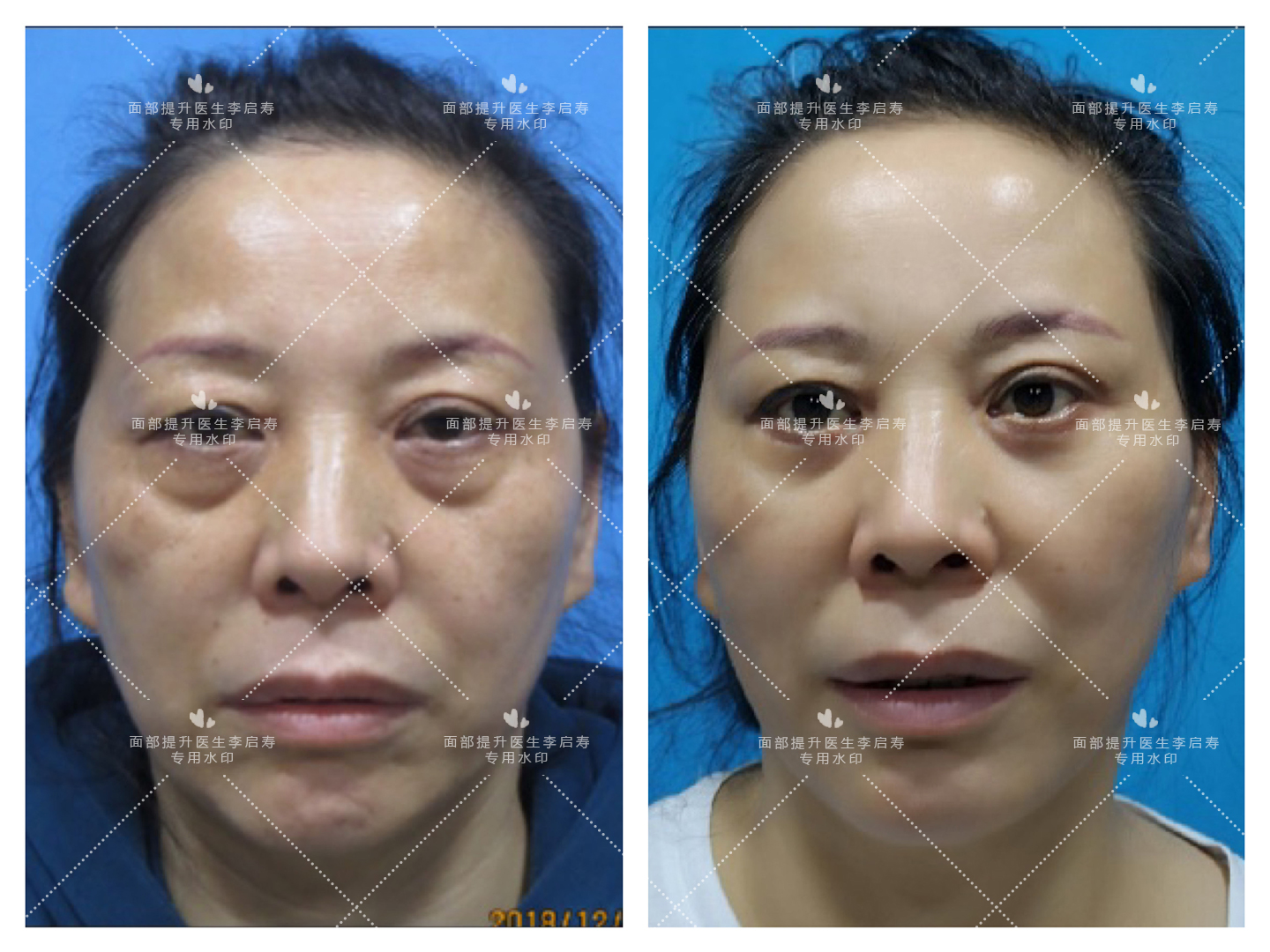 经常耷拉的脸容易长法令纹,大眼袋法令纹抬头纹眼皮耷拉