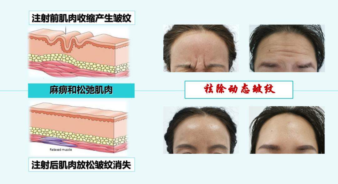 美容针肉毒素副作用有哪些,美容针为什么要打肉毒素